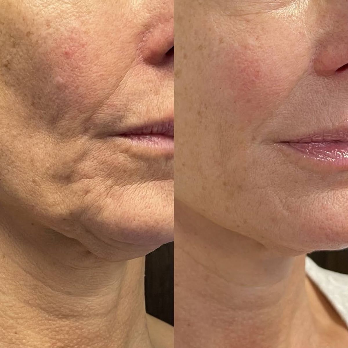 Anti-Aging Serum Stick met Bijengif-Peptiden voor Rimpelvermindering