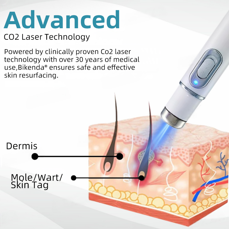 CO₂-Laserpen voor Wratten, Moedervlekken & Pigmentvlekken Verwijderen