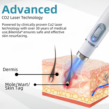 CO₂-Laserpen voor Wratten, Moedervlekken & Pigmentvlekken Verwijderen
