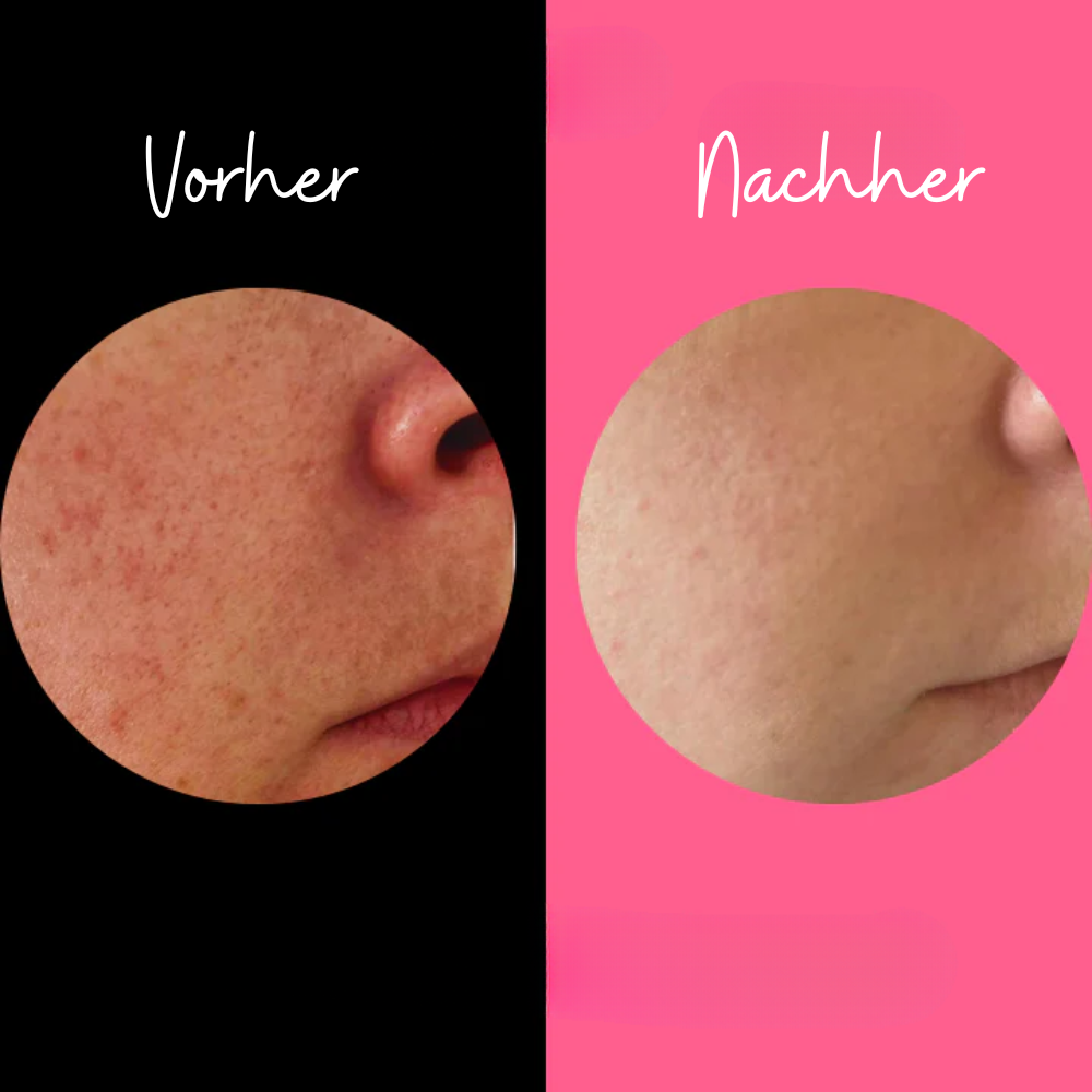 Zachte Exfoliatie-spons voor Gevoelige Huid – Chemicaliënvrij
