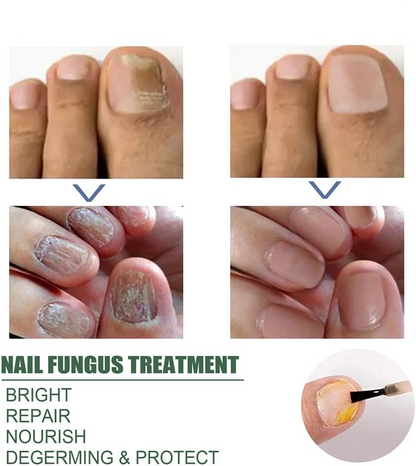 Nagelschimmel Behandeling Serum voor Gezondere en Sterkere Nagels