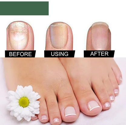 Nagelschimmel Behandeling Serum voor Gezondere en Sterkere Nagels