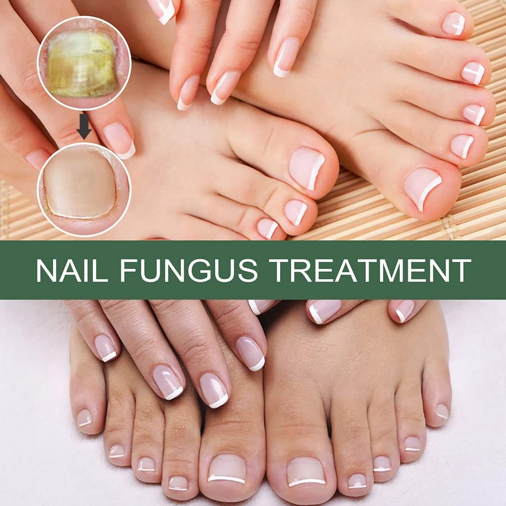 Nagelschimmel Behandeling Serum voor Gezondere en Sterkere Nagels