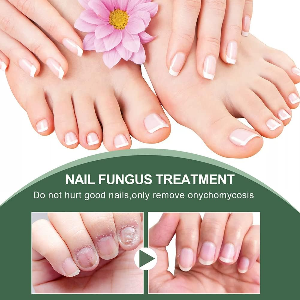 Nagelschimmel Behandeling Serum voor Gezondere en Sterkere Nagels